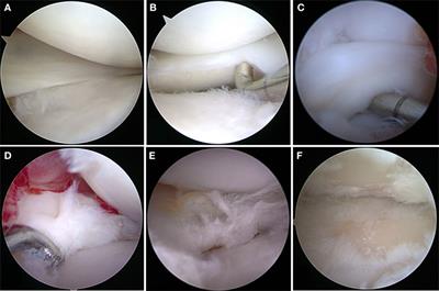 The Pathobiology of the Meniscus: A Comparison Between the Human and Dog